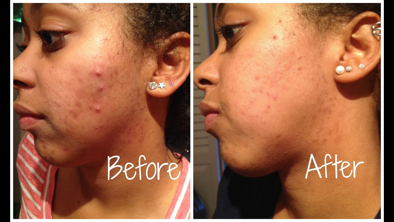 Before and After Photos Cosmetic Treatment Before and After Photos Cosmetic Treatment