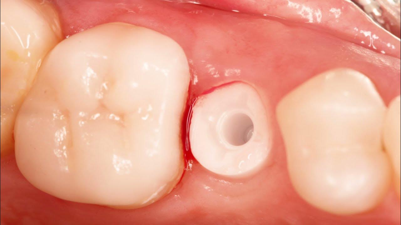 Immediate Zirconia ZSystems Implant for an Extracted Premolar YouTube