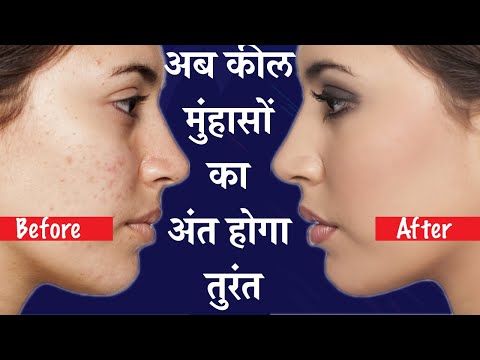 अब कील मुंहासों का अंत होगा तुरंत | Pimples Kaise Hote hai Aur Theek Karne ke Tarike in Hindi