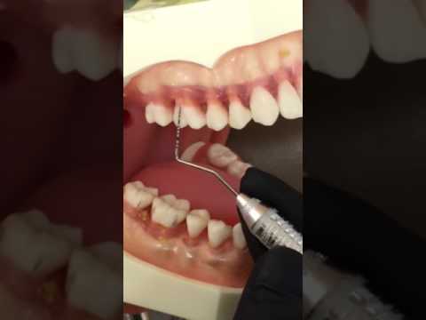 Professor Norrell: How to Measure Gingival Recession
