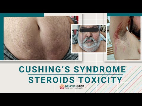 Cushing syndrome #signs #steroids effect on the body  #purplestriae #moonface #glucocorticoids