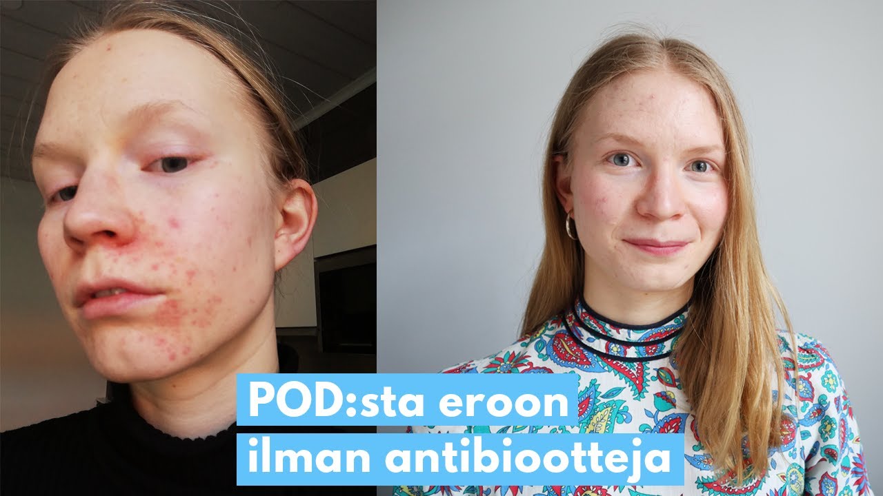 Miten iho-ongelmat teki musta vegaanin (tai täysin kasvipohjaisesti syövän) | Pääsin eroon POD:sta