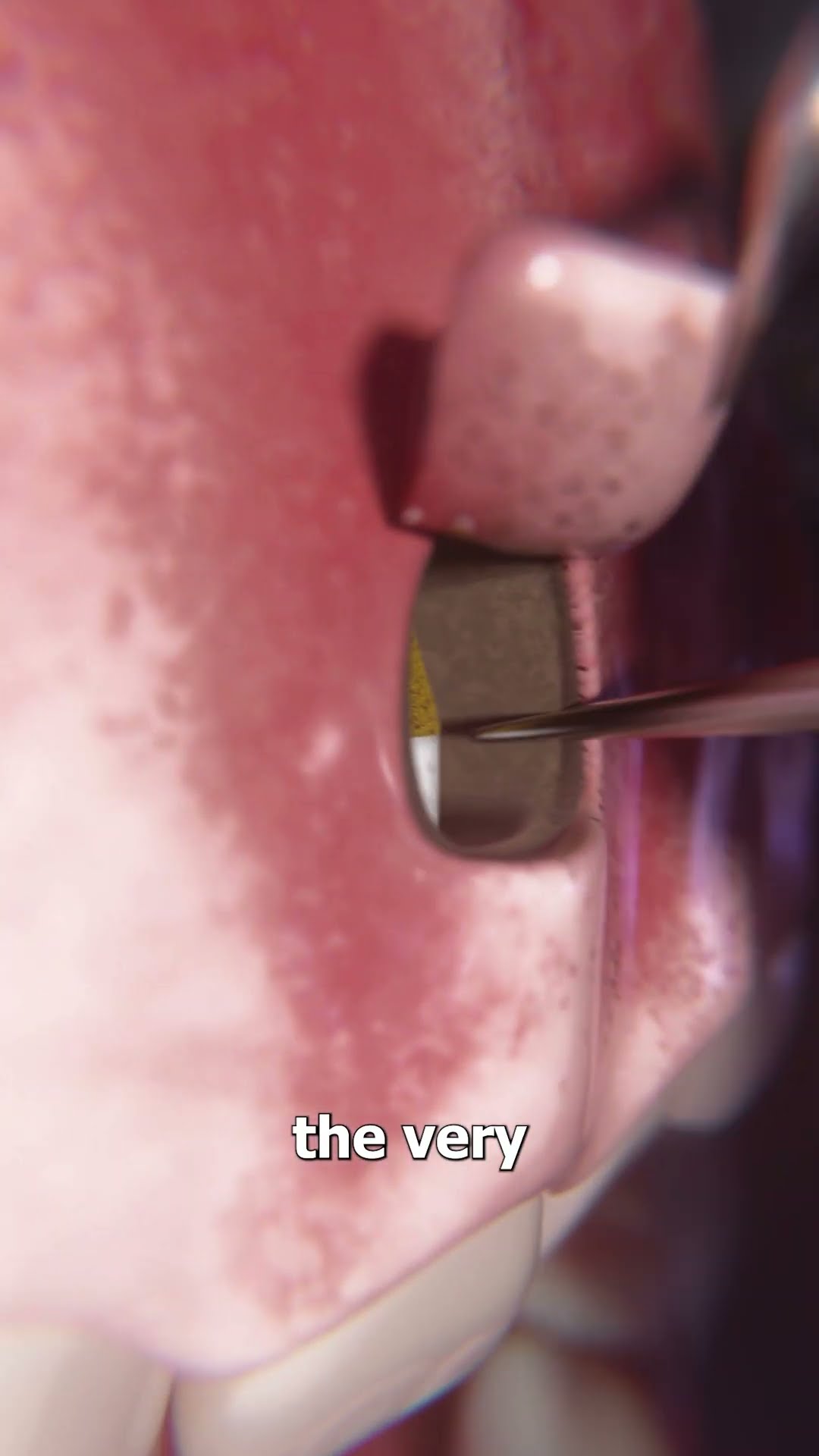 Fixing A Tooth's Root ?