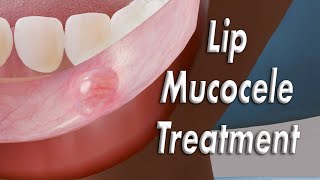 Inner Lip Mucocele (Inside Lip Bump) Surgical Treatment