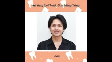 Sự thay đổi trước và sau khi niềng răng lộn xộn của Lê Duy
