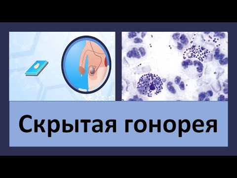 Скрытая гонорея