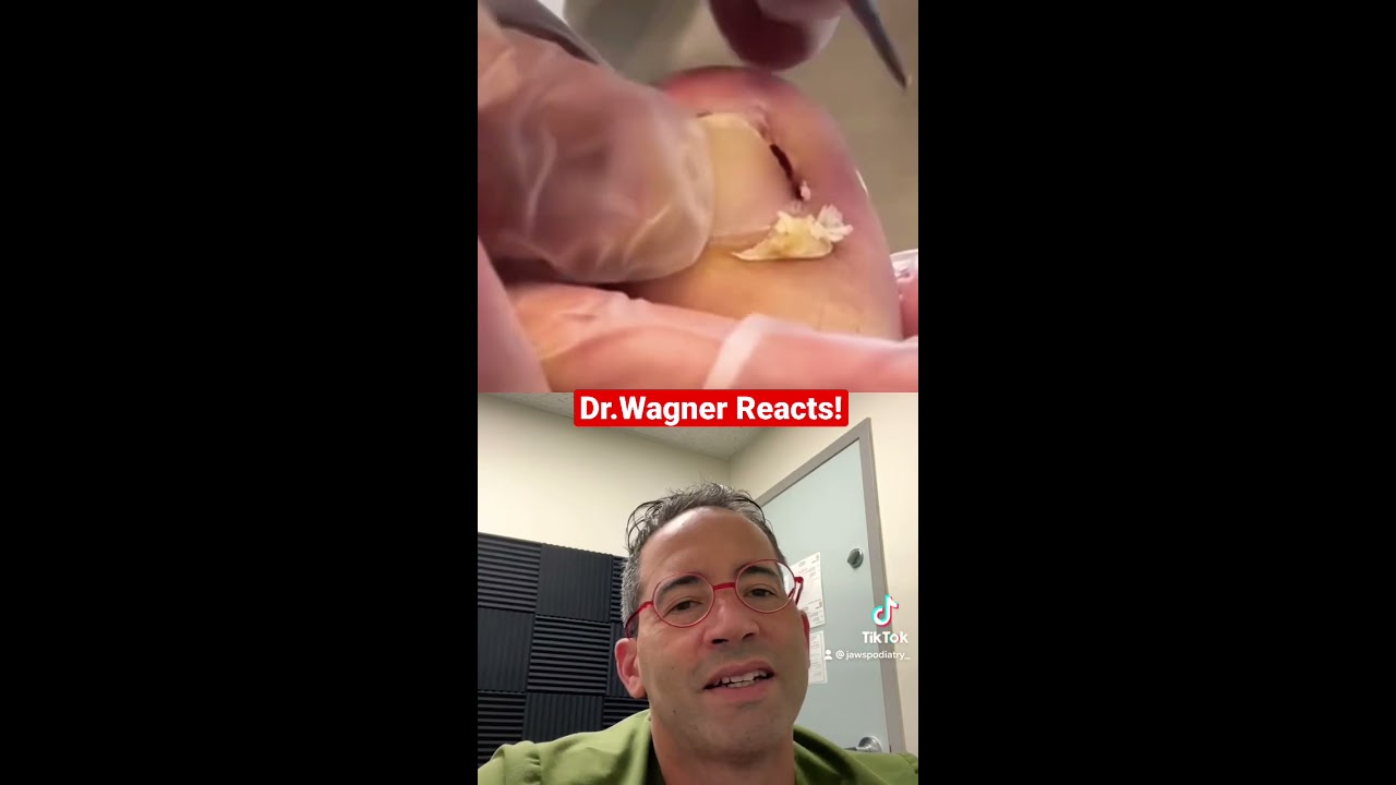 EXTRACTION OF INGROWN TOENAIL Shorts Ingrownnail Ingrown Ingrowntoenail