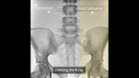 [C-ARM]OSCAR Series - Collimation