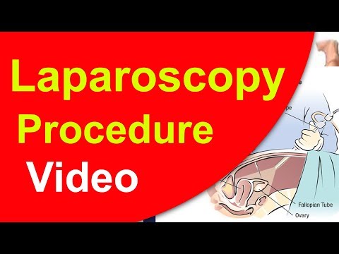 லேப்ராஸ்கோபி-அறுவைசிகிச்சை-முறை|-laparoscopy-for-infertility-in-tamil-|-ivf-iui-icsi-testtube-baby