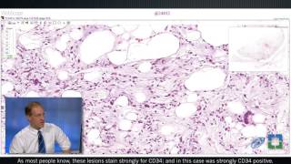 Pathology Insights: Well-Differentiated Lipomatous Tumors with John Goldblum, MD screenshot 5