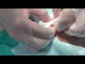 ⑨ 粉瘤くりぬき法 epidermal cyst atheroma cystic acne extraction 脂肪腫 lipoma クリニーク大阪心斎橋 大阪梅田院 名古屋栄院 福岡天神院 三宮院