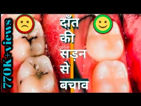 दाँतो में सड़न  कैसे  ठीक करें दर्द?  | Cavity Treatment Pain Relief? HOW? | Dr.Praveen Bhatia