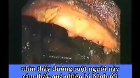 Đường ruột của bạn bẩn như nào? NỘI SOI ĐƯỜNG RUỘT và SỨC KHOẺ  Dr  Hiromi Shinya