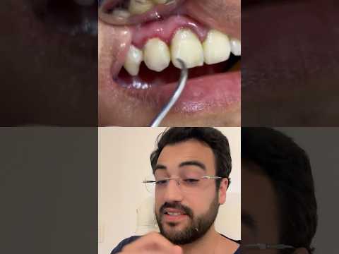 Vídeo: As luminárias podem deixar os dentes mais longos?