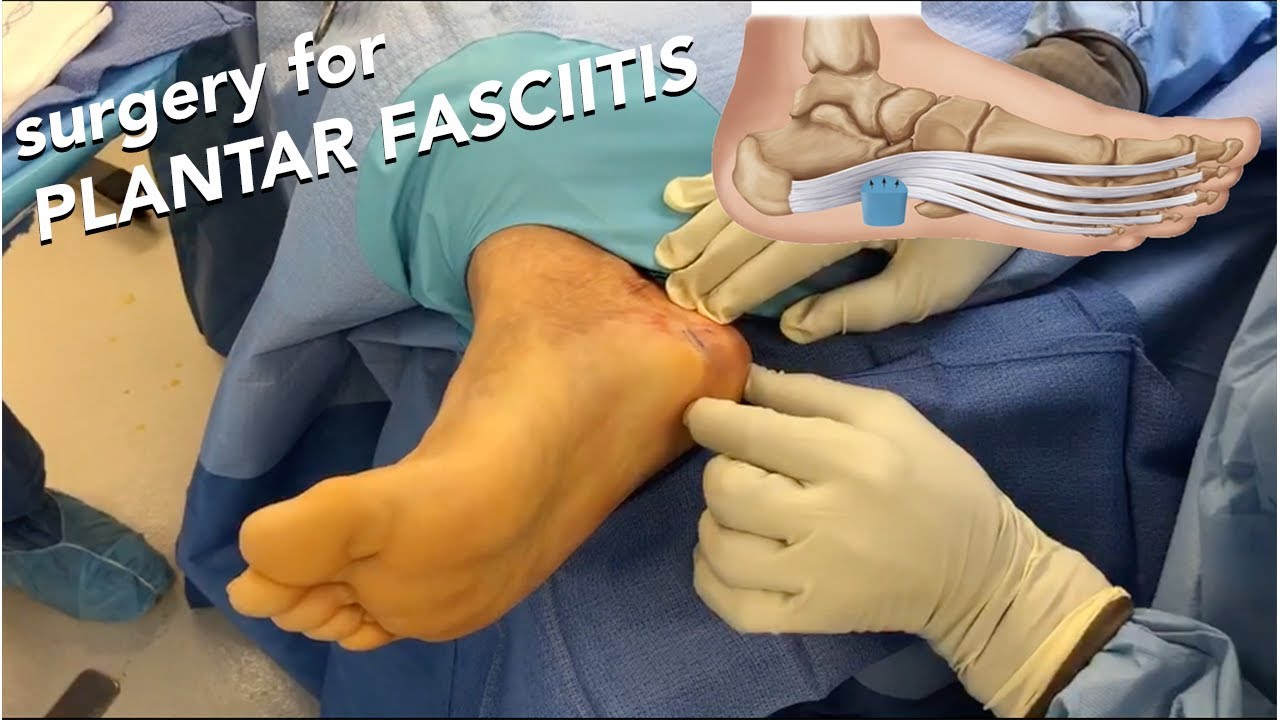 Surgery for PLANTAR FASCIITIS YouTube