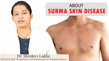 Surma Skin Disease || सुरमा कारण और उपाय  || - Tinea Versicolor Treatment by HealthFirst All in 1