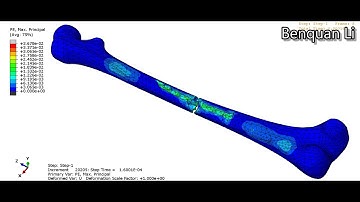 ABAQUS femur bone failure simulation