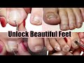 Transform Your Feet: Mesmerizing Pedicure Compilation for Impacted, Ingrown, and Pincer Toenails
