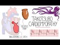 Takotsubo Cardiomyopathy Explained  (Broken Heart Syndrome)