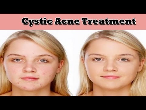 Cystic Acne Treatment/Cystic Acne Treatment Home Remedy- Stay Healthy - Number Source of Health