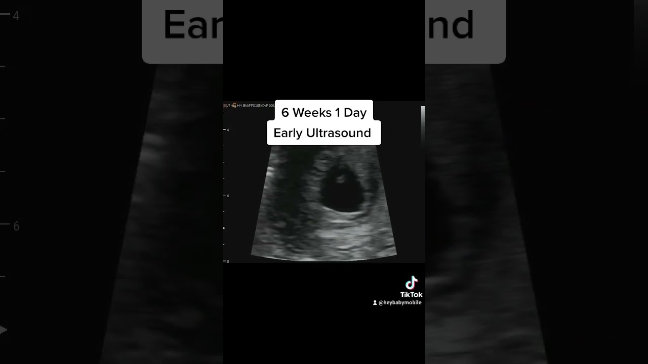 Heartbeat On Early Ultrasound At 6 Weeks 1 Day Pregnant