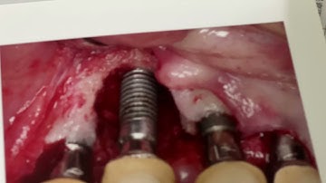 インプラント周囲炎🔥【予告】