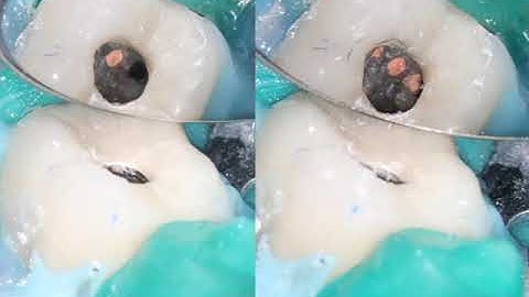 The use of CBCT scans in Endodontics