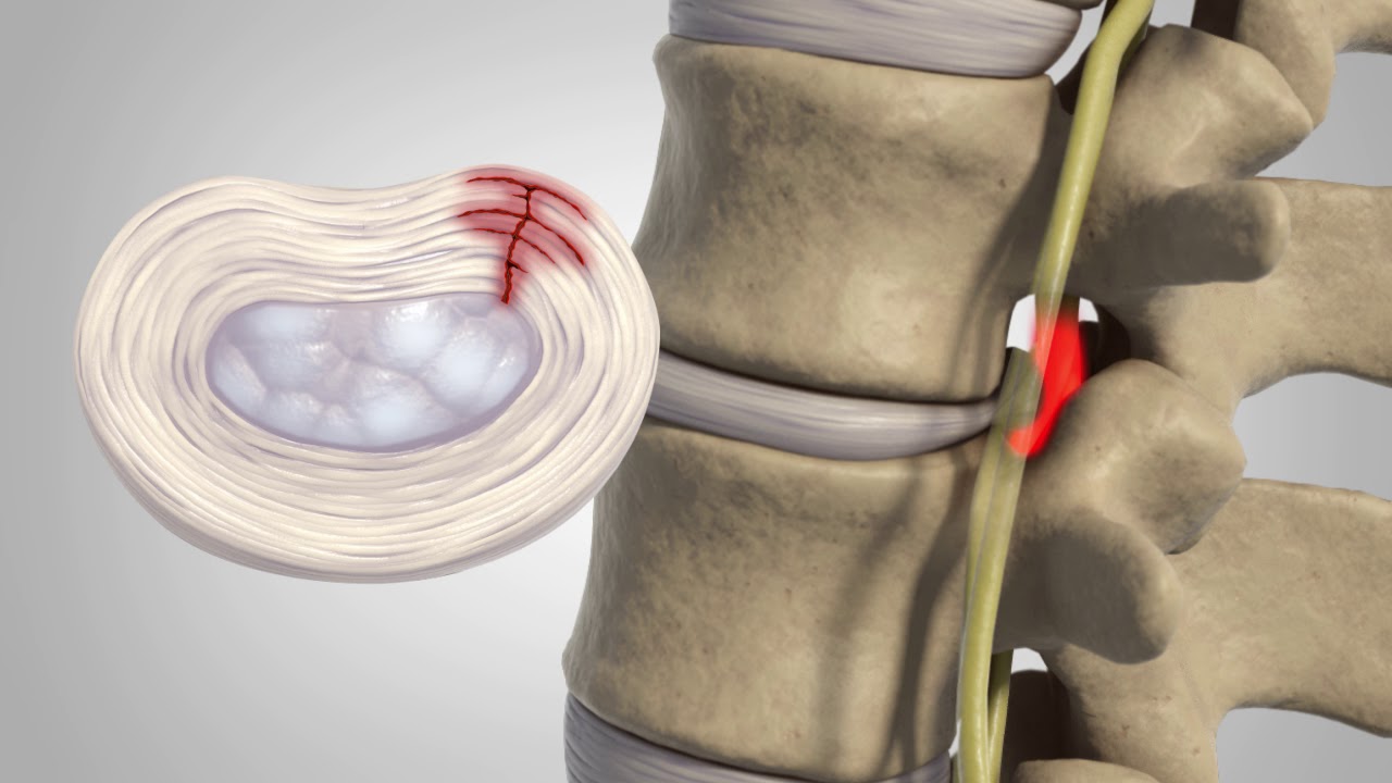 Could A Herniated Disc Be The Cause of Your Back Pain? - Peak Ortho