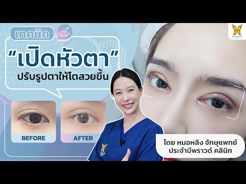 เทคนิคการ เปิดหัวตา ปรับรูปตาให้โตสวย โดย หมอหลิง จักษุแพทย์เฉพาะทาง Beproud Clinic