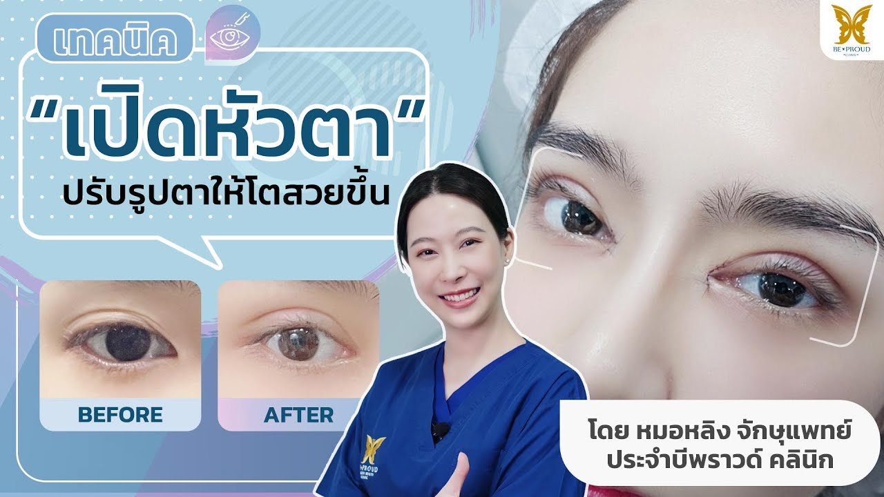 เทคนิคการ เปิดหัวตา ปรับรูปตาให้โตสวย โดย หมอหลิง จักษุแพทย์เฉพาะทาง  Beproud Clinic - Youtube