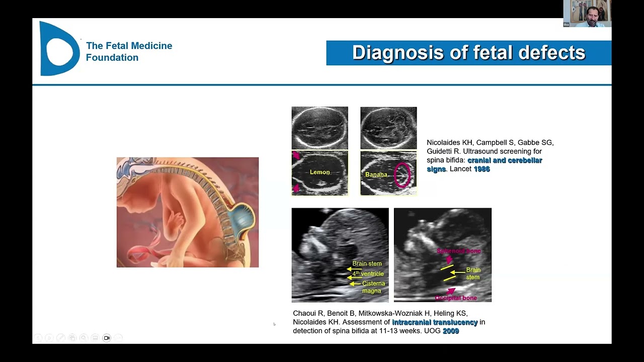 Turning the pyramid of prenatal care by Prof Kypros Nicolaides(UK)