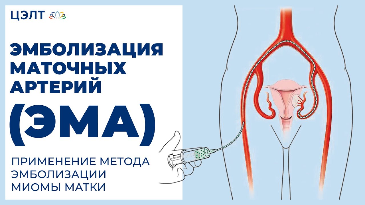 что такое мюлекс