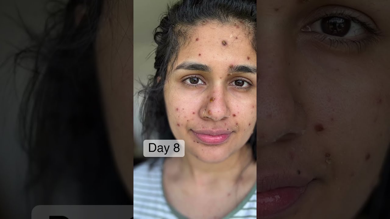 Chicken Pox Days This Too Shall Pass Staystrong Nothingserious