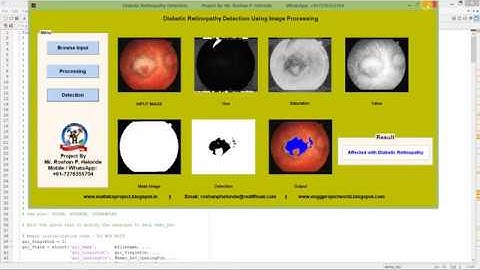 Matlab Code for Diabetic Retinopathy Detection Using Image Processing