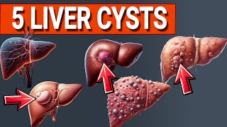 Top 5 Liver Cysts Explained: What You Need to Know!
