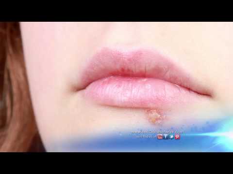 stds:-medical-minute-with-family-physician-dr.-richard-honaker