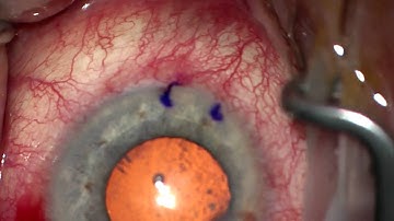 Targeted iStent Implant (Glaukos) for Glaucoma (Generation 1)