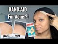 BAND-AID FOR ACNE?! | I Tested Hydrocolloid Bandages for 1 Week | Hydro Seal Band-Aid for Acne