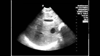 Ultasound Troubleshoot The Common Bile Duct Cbd