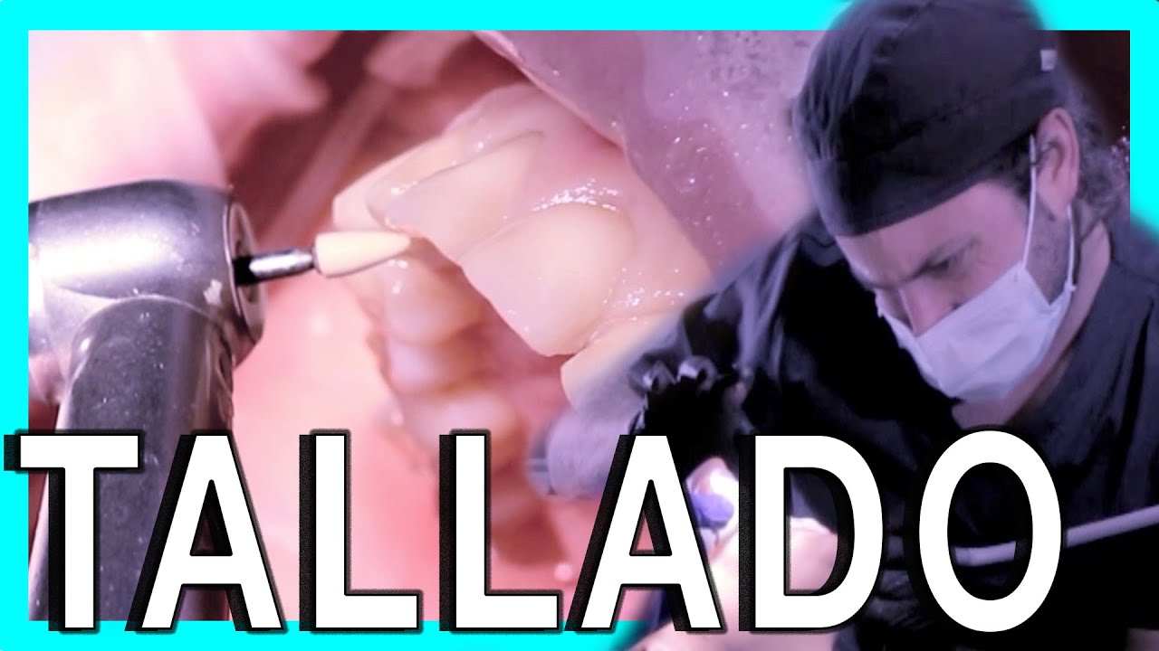 👉TALLADO CARILLAS FELDESPATICAS . Como se realiza el tallado paso a paso para colocar carillas. diseño de sonrisa medellin precio