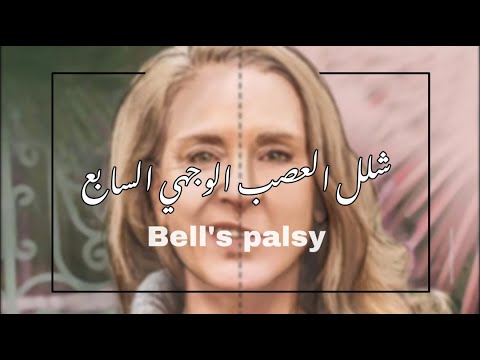 شلل بيل، شلل العصب الوجهي السابع، اللقوة المحيطية، تمارين علاجية، علاج، bell&rsquo;s palsy #علاج_طبيعي