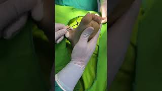 foot deformity correction