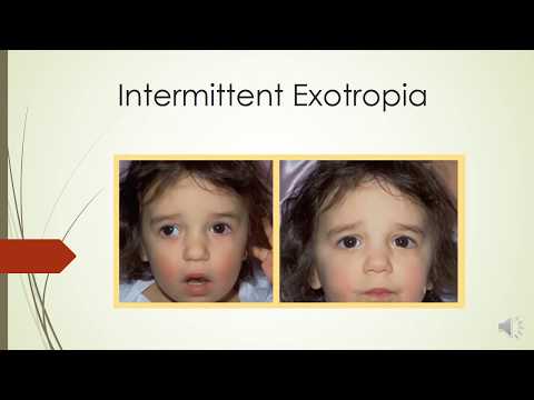 Video: Exotropia: Simptomi, Upravljanje I Još Mnogo Toga