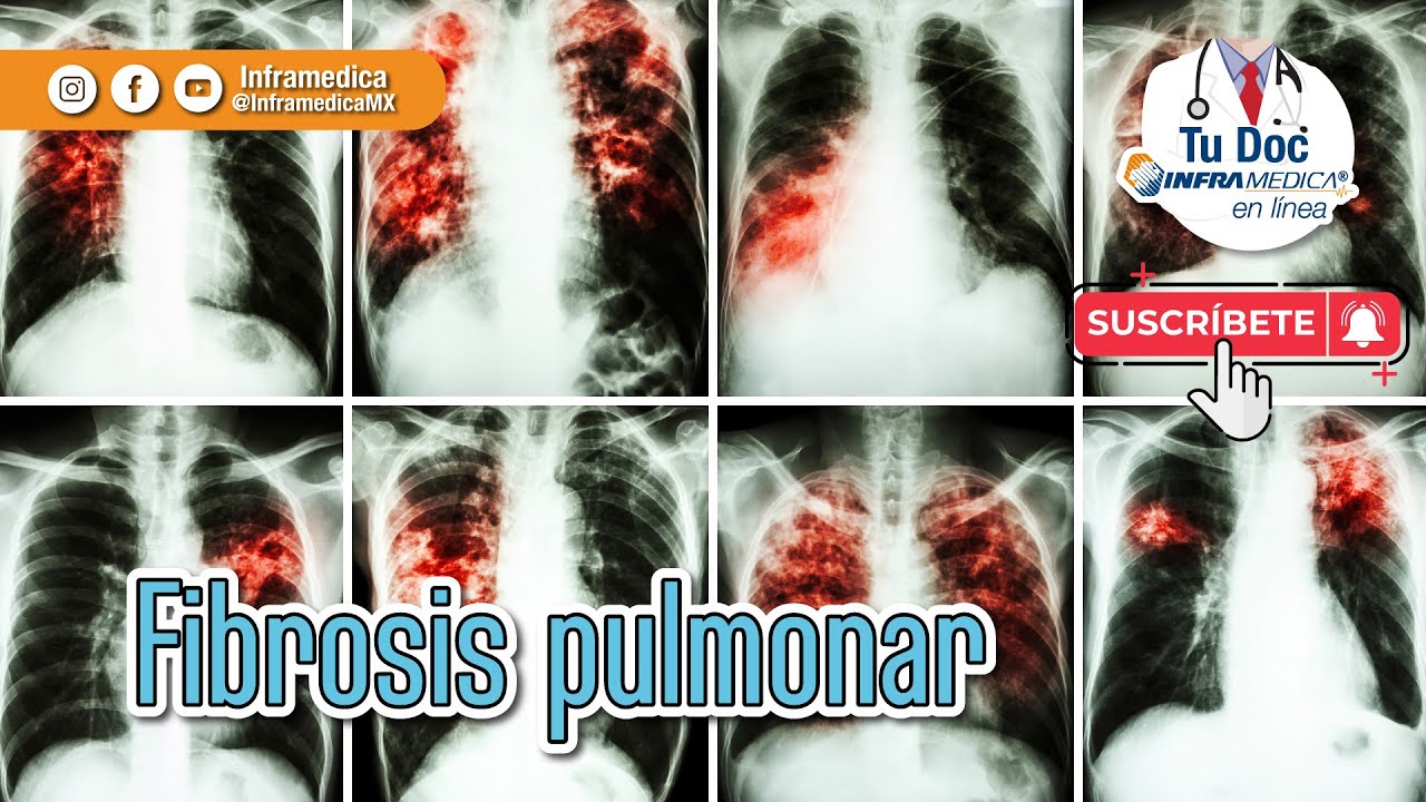 ¿Qué es la fibrosis pulmonar? 👨🏻‍⚕
