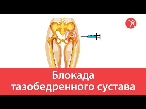 Изображение - Блокада при коксартрозе тазобедренного сустава отзывы hqdefault