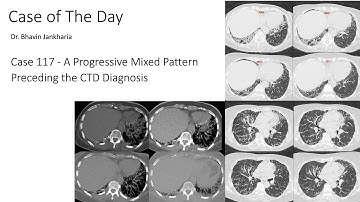 Case of the Day - 117 - 2025 10 13 - A Progressive Mixed Pattern Preceding the CTD Diagnosis