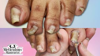 👣Curling Wavy PINCHING TOENAILS How to Clean & Restore👣
