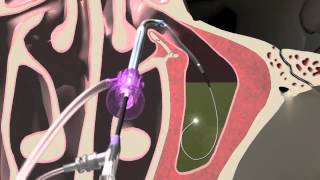 Balloon Sinuplasty Animation of the Maxillary Sinus | Seattle Sinus Surgeon