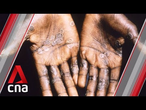 Singapore's first case of monkeypox: What you need to know ...
