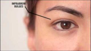 Information on Blepharoplasty  Dr Bryan Mendelson